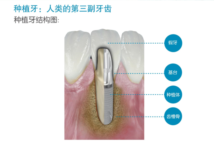  深圳義齒加工